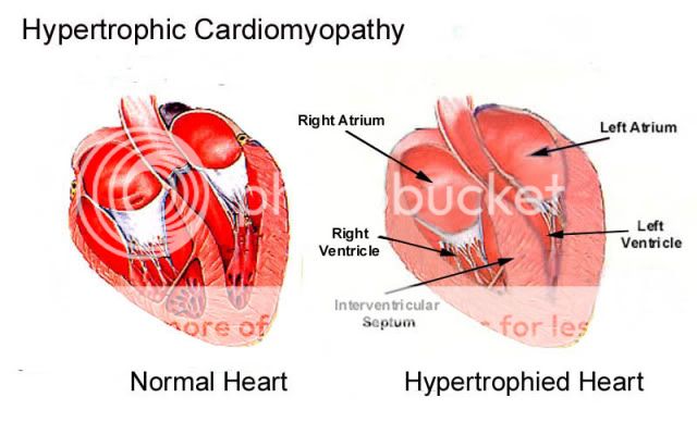 Hypertrophic_Cardiomyopathy-Dia.jpg